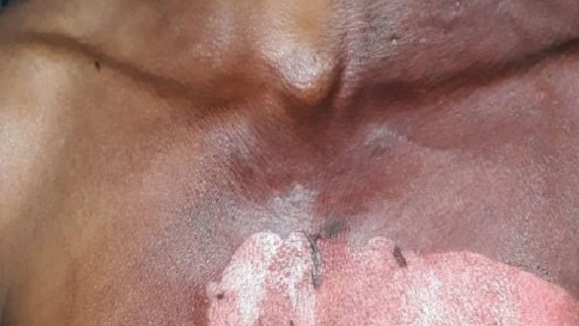 Mulher joga água quente no marido e provoca queimaduras de segundo grau durante discussão em MS